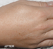 <?php echo $pk;?>  - Laser Hair Removal After Treatment 04