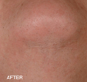 <?php echo $pk;?>  - Laser Hair Removal After Treatment 05