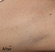 <?php echo $pk;?>  - Laser Hair Removal After Treatment 06