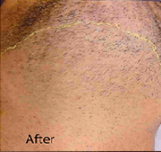 <?php echo $pk;?>  - Laser Hair Removal After Treatment 07