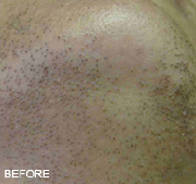 <?php echo $pk;?>  - Laser hair removal before treatment 01