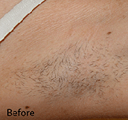 <?php echo $pk;?>  - Laser Hair Removal Before Treatment 06