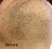 <?php echo $pk;?>  - Laser Hair Removal Before Treatment 07