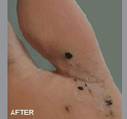 <?php echo $pk;?>  - Laser Wart Removal After Treatment 01
