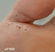 <?php echo $pk;?>  - Laser Wart Removal After Treatment 02