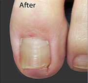 <?php echo $pk;?>  - Nail Fungus Treatment After  01