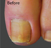 <?php echo $pk;?>  - Nail Fungus Treatment Before  01