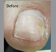 <?php echo $pk;?>  - Nail Fungus Treatment Before  02