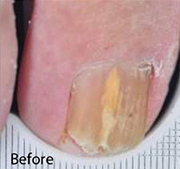 <?php echo $pk;?>  - Nail Fungus Treatment Before  03