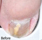 <?php echo $pk;?>  - Nail Fungus Treatment Before  04