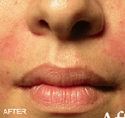 <?php echo $pk;?>  - Radiesse After Treatment 01