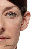<?php echo $pk;?>  - Radiesse After Treatment 02