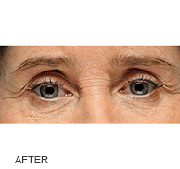 <?php echo $pk;?>  - Restylane After Treatment 01