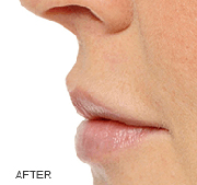 <?php echo $pk;?>  - Restylane After Treatment 05