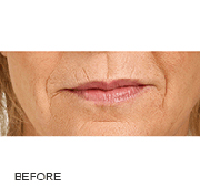 <?php echo $pk;?>  - Restylane before Treatment 02