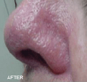 <?php echo $pk;?>  - Vein Treatment After  04