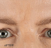 <?php echo $pk;?>  - Xeomin After Treatment 01