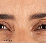 <?php echo $pk;?>  - Xeomin After Treatment 02