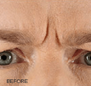 <?php echo $pk;?>  - Xeomin Before Treatment 01