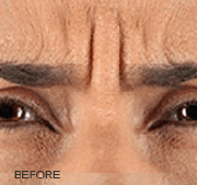 <?php echo $pk;?>  - Xeomin Before Treatment 02