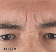 <?php echo $pk;?>  - Xeomin Before Treatment 03