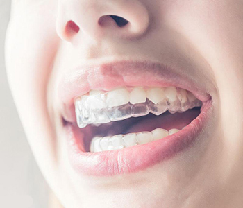 Invisalign Braces Knoxville