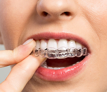 Invisalign Knoxville TN
