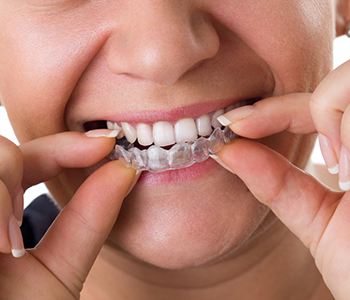 Invisalign Orthodontics Knoxville