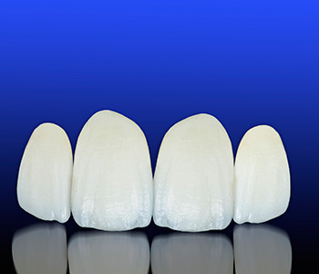 Dr Foncea says What are Porcelain Veneers
