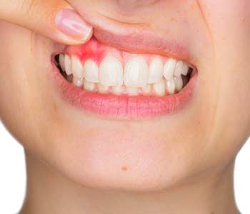 Learn about the diagnosis and treatment of gum disease with our dentist in Knoxville, TN