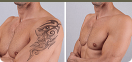 <?php echo $pk;?> - Picosure Tattoo Removal