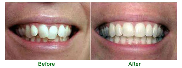 <?php echo $pk; ?> - Before and After - Case 1