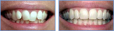 <?php echo $pk;?> - Before After 02