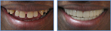 <?php echo $pk;?> - Before and After - Case 04