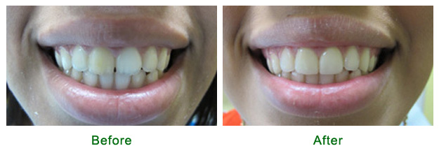 <?php echo $pk; ?> - Before and After - Case 1