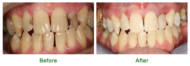 <?php echo $pk; ?> - Before and After - Case 1