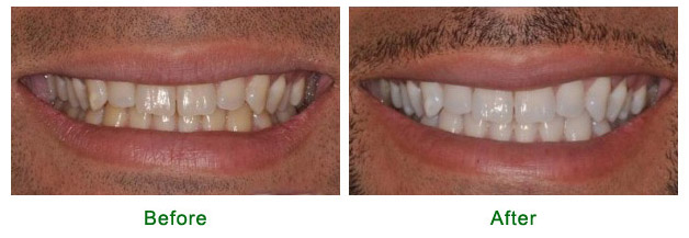 <?php echo $pk; ?> - Teeth Whitening Before and After