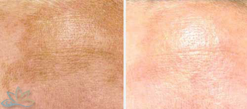 Photo Gallery - Chemical Peels Image 01
