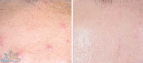 Photo Gallery - Chemical Peels Image 02