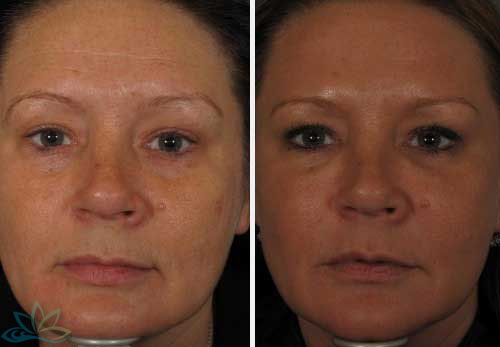 Injectable Filler Jacksonville - Dermal Fillers Image 01