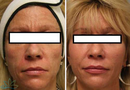 Injectable Filler Jacksonville - Dermal Fillers Image 02