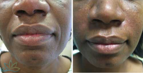 Injectable Filler Jacksonville - Dermal Fillers Image 03