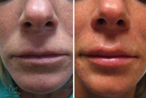 Injectable Filler Jacksonville - Dermal Fillers Image 04