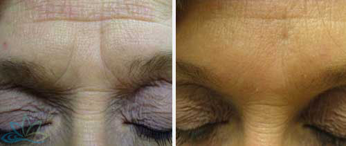 Injectable Filler Jacksonville - Dermal Fillers Image 05