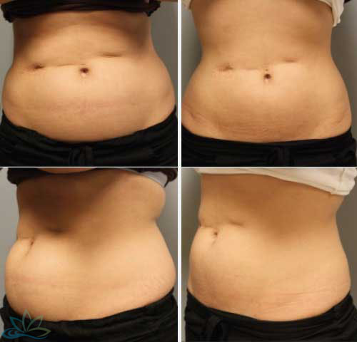 Photo Gallery - Skin Tightening and Fat Reduction Image 01