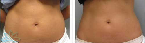 Photo Gallery - Skin Tightening and Fat Reduction Image 03