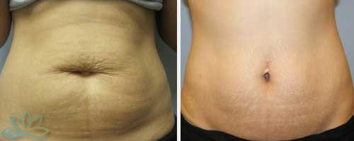 Photo Gallery - Skin Tightening and Fat Reduction Image 04