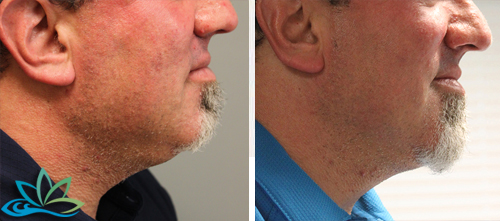 Photo Gallery - Skin Tightening and Fat Reduction Image 04