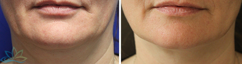 Photo Gallery - Skin Tightening and Fat Reduction Image 04