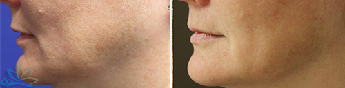 Photo Gallery - Skin Tightening and Fat Reduction Image 04